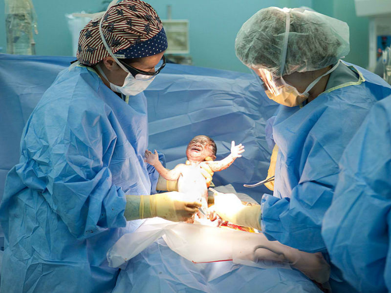 cesarean section delivery