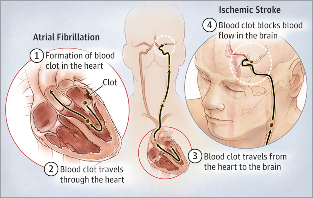 atrial fibrillation