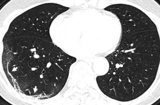 Coronavirus Update: Ravage Lung X-Ray Photos Show How Coronavirus Could Kill You Softly... But Surely? 