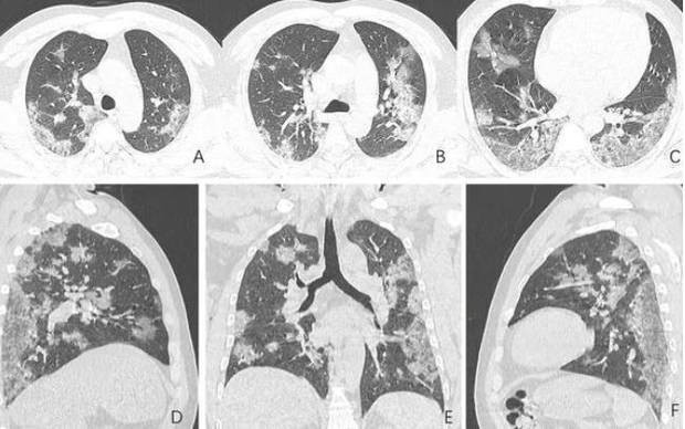 Coronavirus Update: Ravage Lung X-Ray Photos Show How Coronavirus Could Kill You Softly... But Surely? 