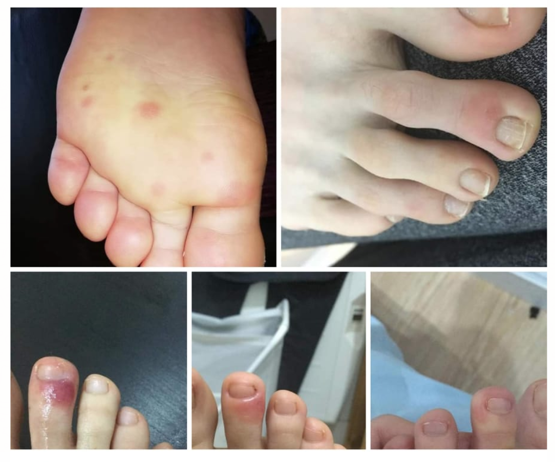 Studies Show That Bruising And Chickenpox Like Lesions On Feet