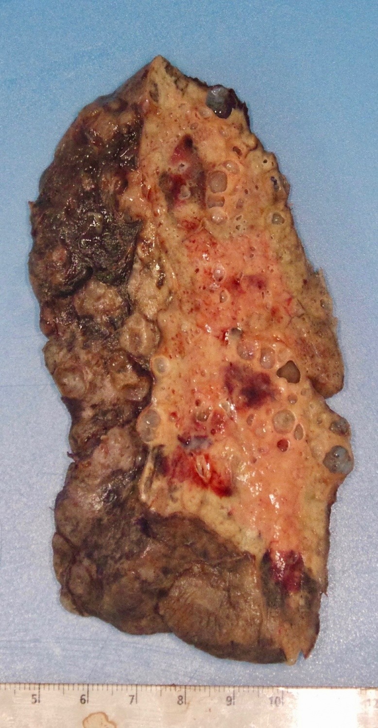 Patient's COVID lung
