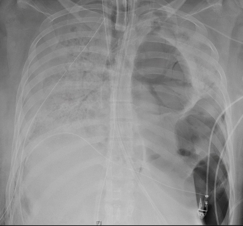 Patient's COVID lung x-ray