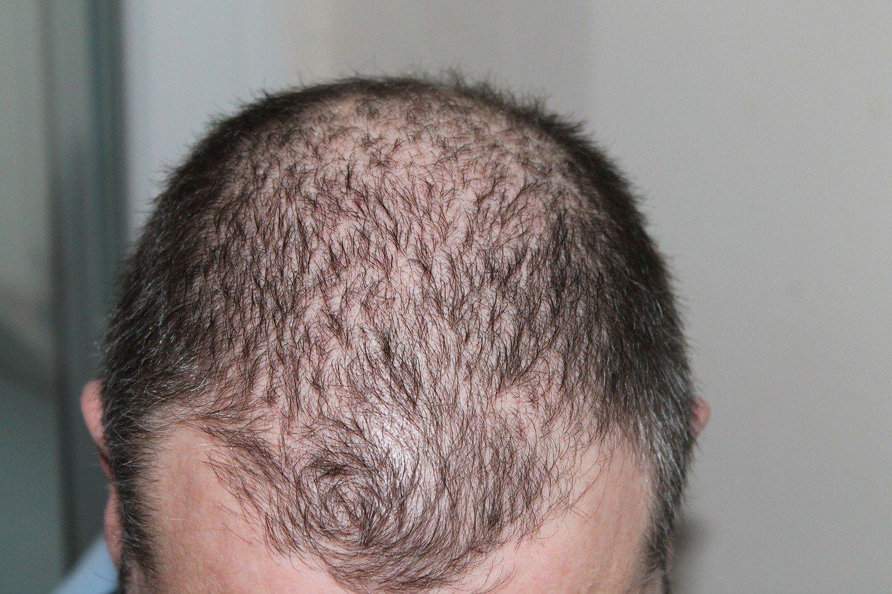 How to Deal with Male Pattern Baldness | Tech Times