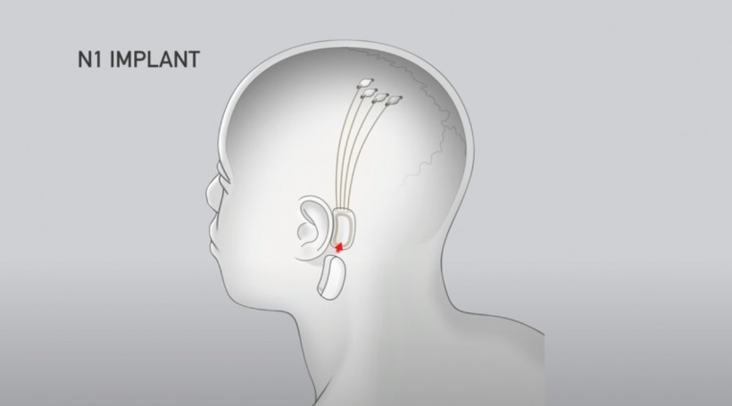 Neuralink implant