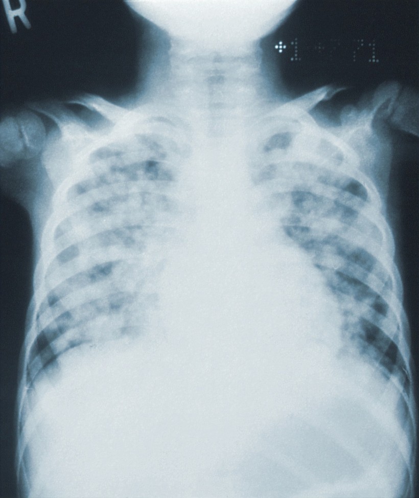 New chest x-ray tool uses Artificial Intelligence to detect Covid-19 with 83% accuracy 