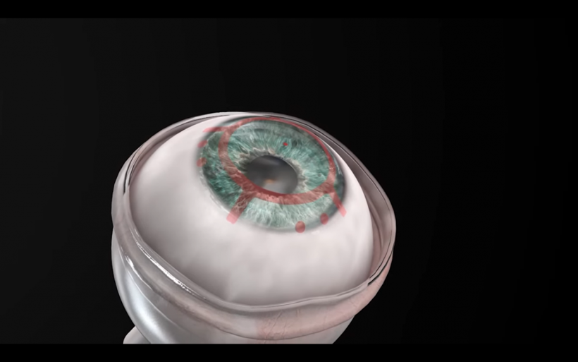 artificial cornea CorNeat KPro