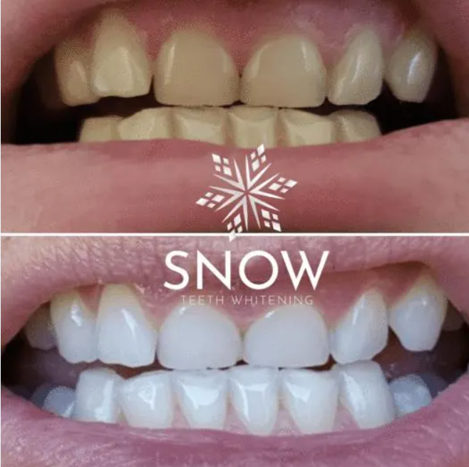 How does Snow® Teeth Whitening Kit work?