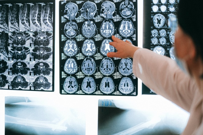 Scientists jumpstart brain of coma patients with ultrasound