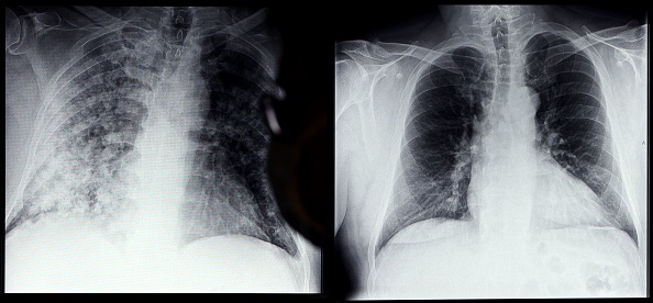 New COVID-19 X-Ray Images of Unvaccinated and Vaccinated Lungs Show Alarming Difference in Oxygen Inhalation 