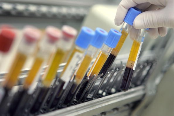 Cheap Blood Tests Could Detect Alzheimer's Early Signs and Prevent the Disease's Progression