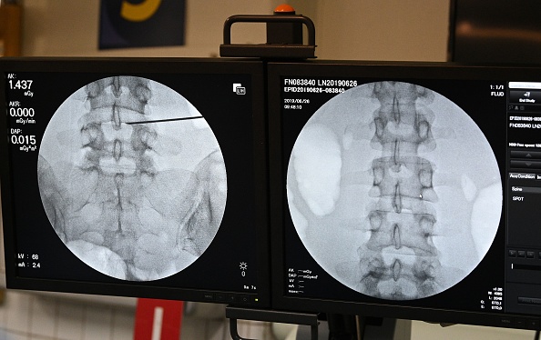 New Smart Spine Implants Could Lead To Less Painful Surgeries, More Efficient Bone Growth Output 