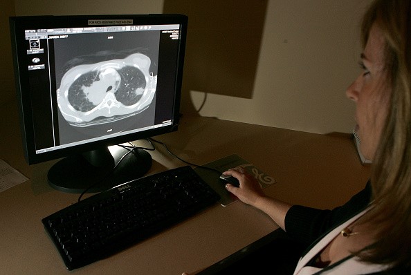 Lung Cancer Early Detection: This Device Could Help Save Lives of Smokers 