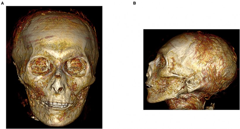 Digital Unwrapping of the Mummy of King Amenhotep I (1525–1504 BC) Using CT