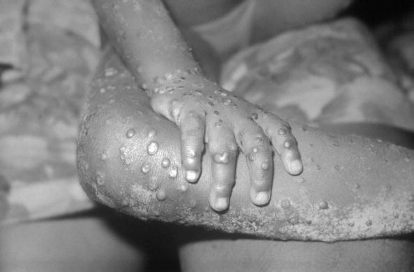 Monkeypox contact tracing is now carried out by Scottish health officials;  Latest case of infection, symptoms and more!