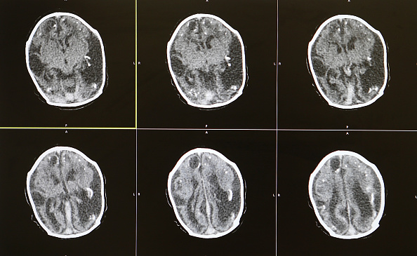 新的痴呆症研究揭示了为什么大脑扫描是必须的——即使疾病是无法治愈的