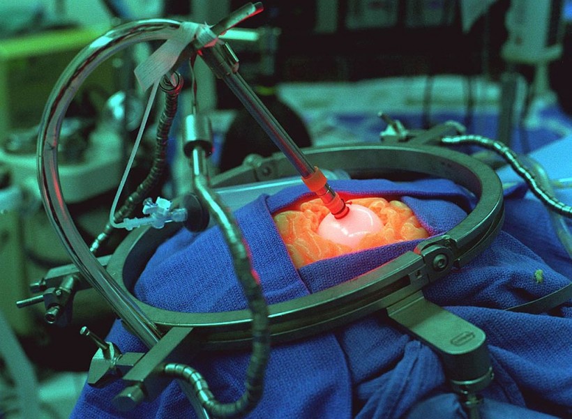 Simulation Of Surgical Implantation Of The Light Emitting Diodes Probe At The Children's Hospital