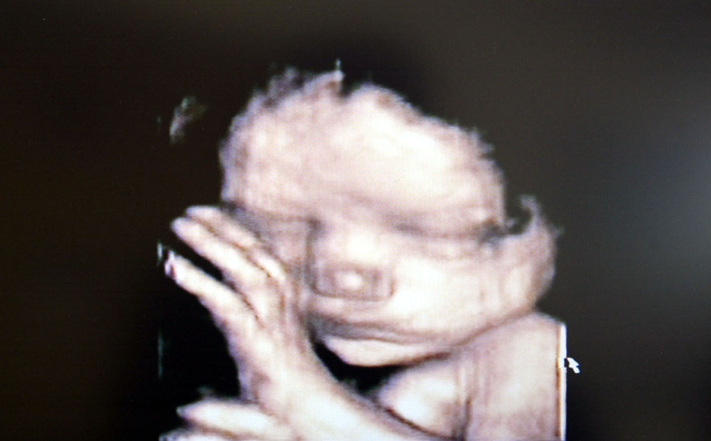 Stock Photography. A 3d Ultrasound Showing A Baby