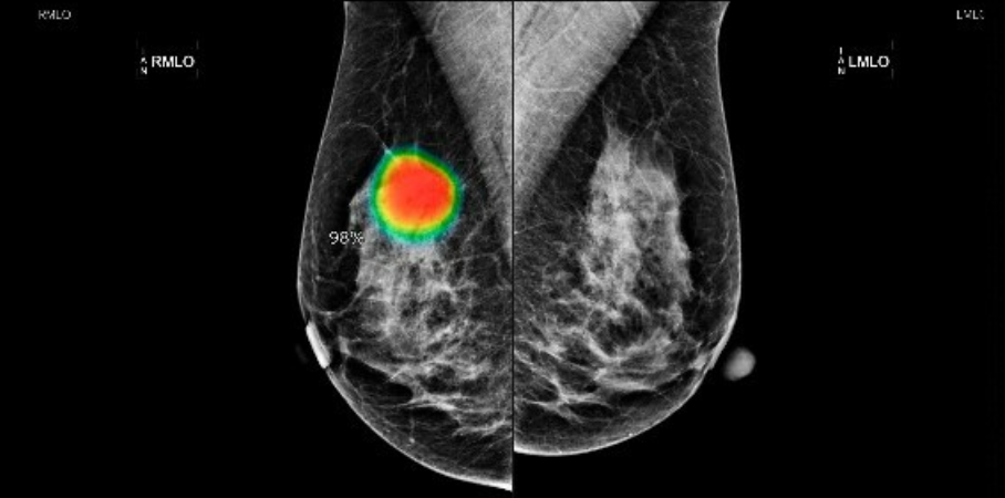 Breakthrough AI Breast Cancer Detection Tool Outperforms Radiologists in Landmark Danish Study