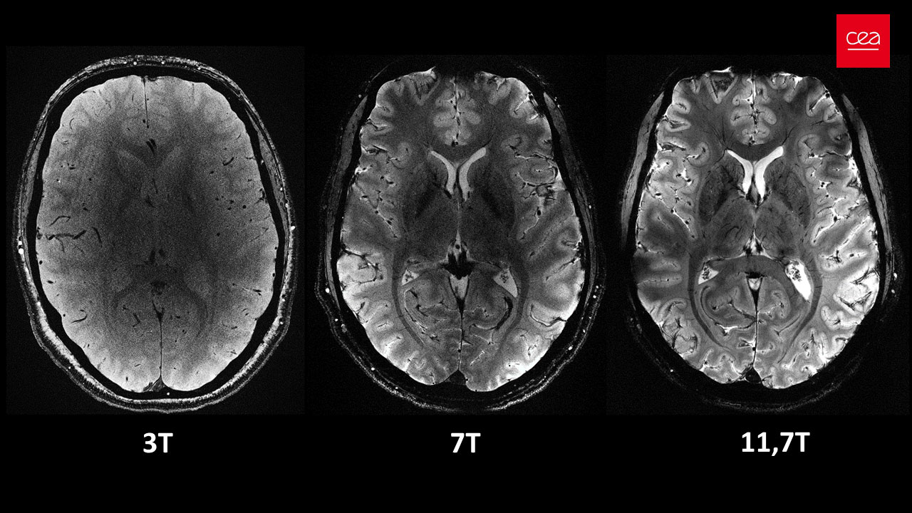 A world premiere: the living brain imaged with unrivaled clarity thanks to the world’s most powerful MRI machine
