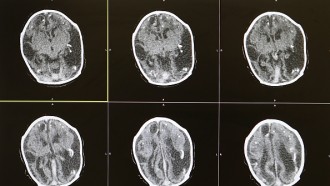 新的痴呆研究揭示了为什么脑部扫描是一个甚至必须如果疾病是无法治愈的