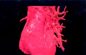 Second Patient Receives Genetically Altered Pig Heart for End-Stage Heart Disease